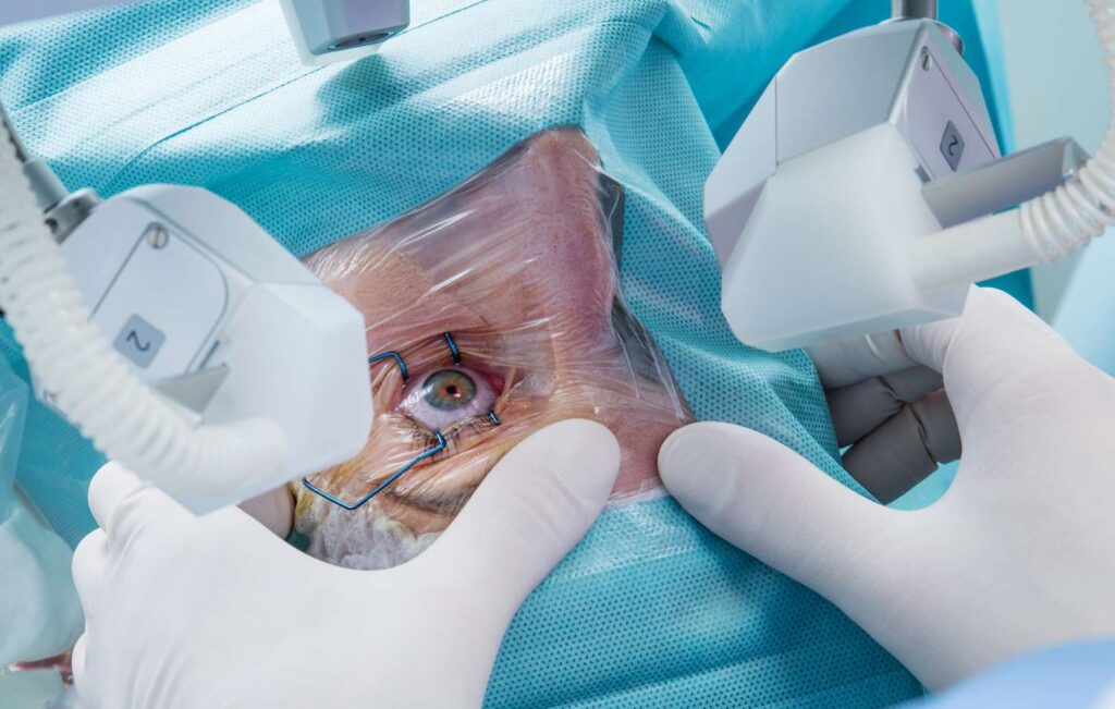 LASIK Eye Operation